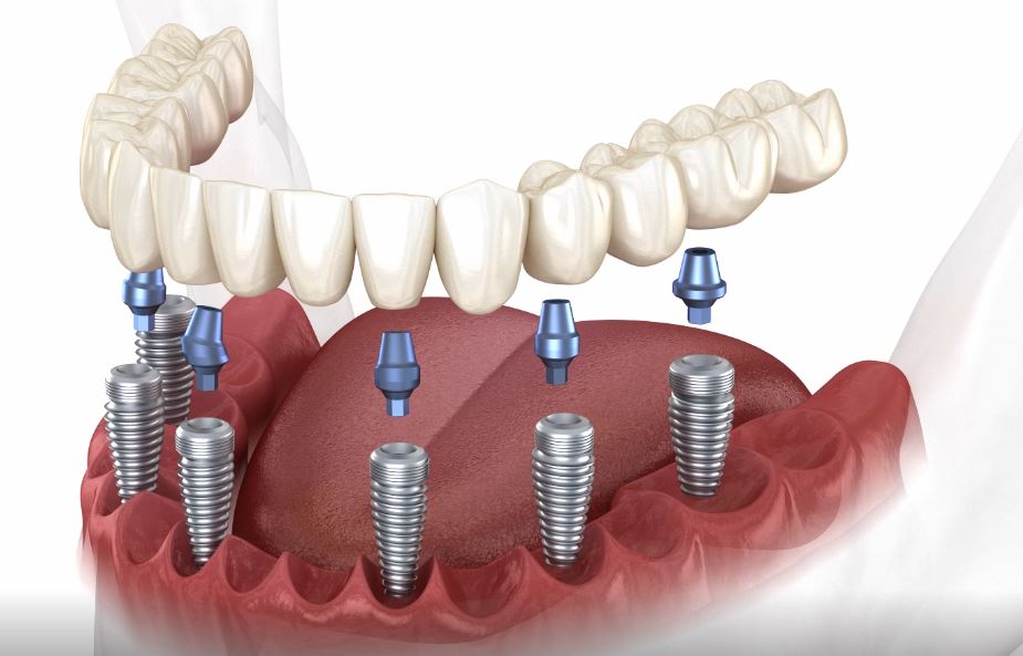 Dental Implants - Best Option